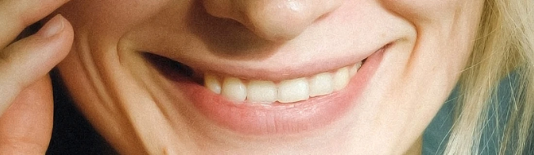 Dentist San Francisco CA Close Up on the Mouth of a Blonde Woman Who Is Smiling Dental Implants Focused Close Up on the Mouth of a Blonde Woman Who Is Smiling Dental Implants Focused